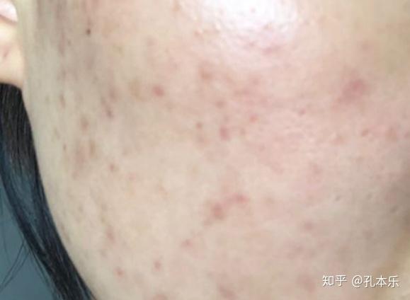 毛囊炎圖片，認識與理解毛囊炎的直觀方式，毛囊炎圖片，直觀認識與理解毛囊炎的指南